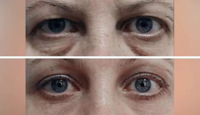 blepharoplasty before and after patient - 4