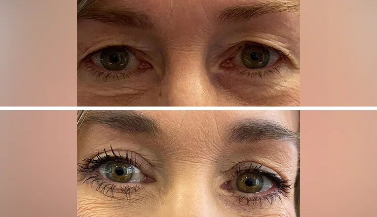 blepharoplasty before and after patient - 6