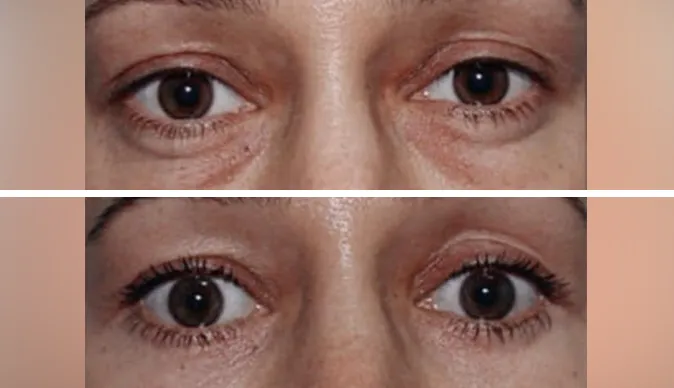 blepharoplasty before and after patient - 7