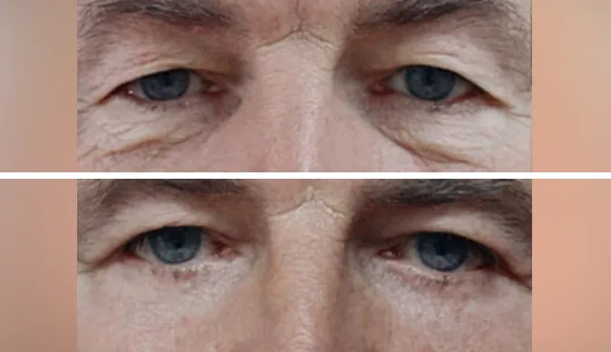 blepharoplasty before and after patient - 8