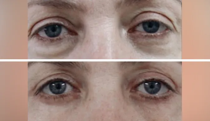 blepharoplasty before and after patient - 9