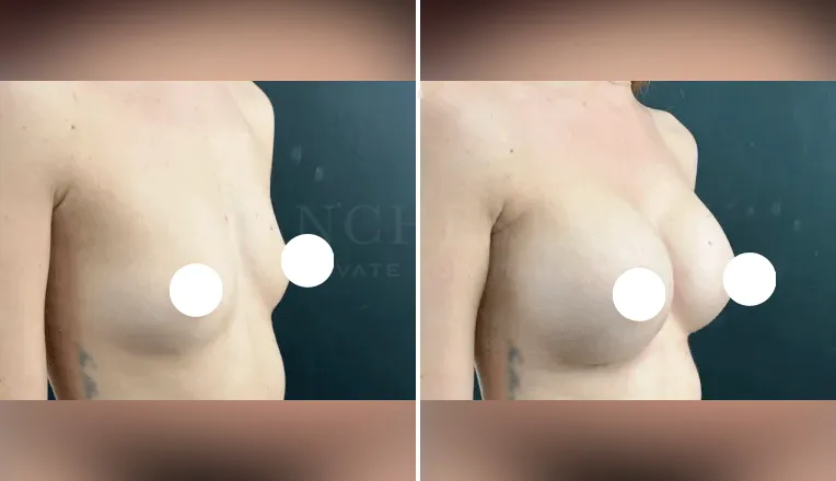 boob job before and after patient - 1 - v2