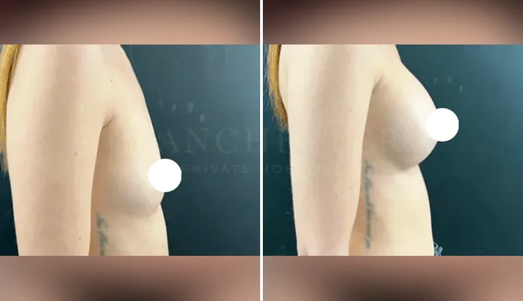 boob job before and after patient - 1 - v3