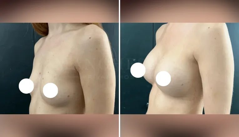 boob job before and after patient - 1 - v4