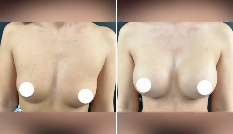 breast augmentation before and after patient - 1 - v1