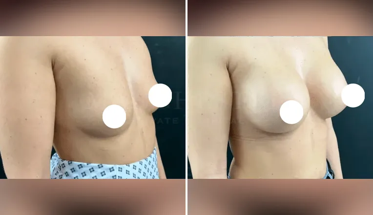 breast augmentation before and after patient - 1 - v2