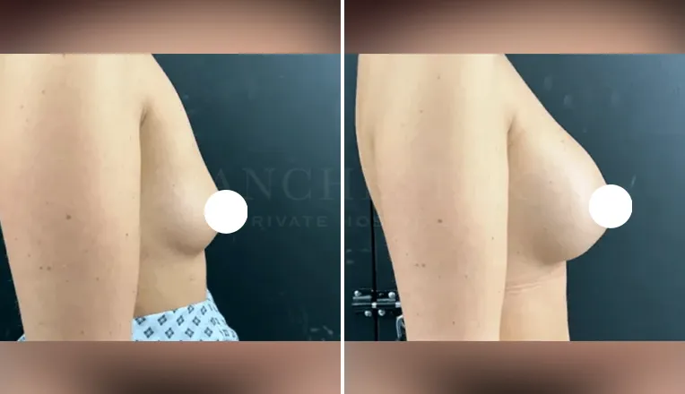 breast augmentation before and after patient - 1 - v4