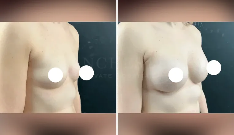 breast augmentation before and after patient - 2 - v2