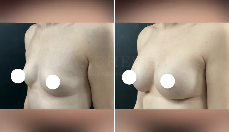 breast augmentation before and after patient - 2 - v3