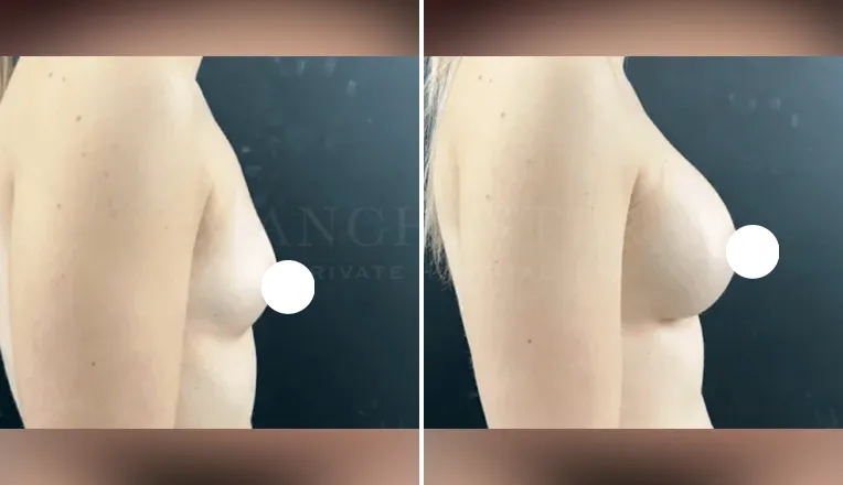 breast augmentation before and after patient - 2 - v4