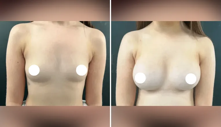 breast enlargement before and after patient - 1 - v1