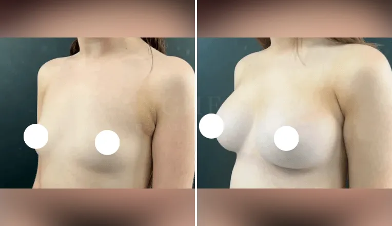 breast enlargement before and after patient - 1 - v3