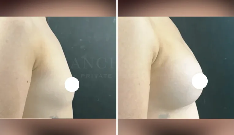 breast enlargement before and after patient - 1 - v4