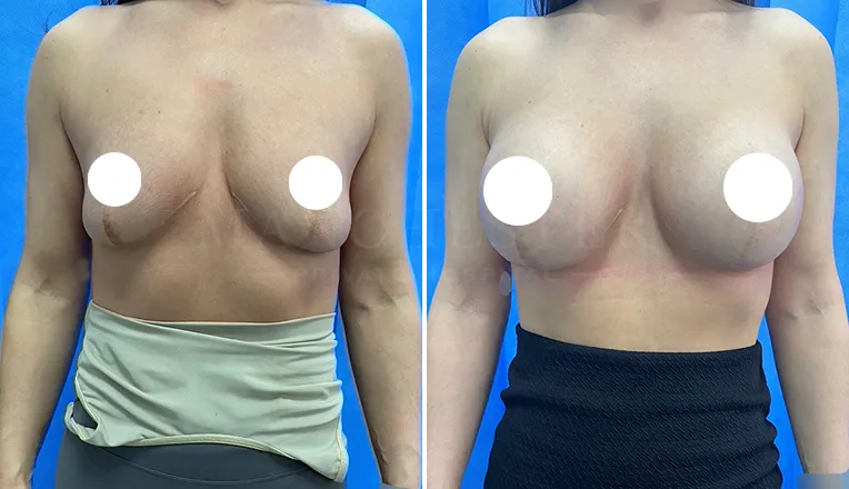 breast enlargement before and after patient - 2 - v1