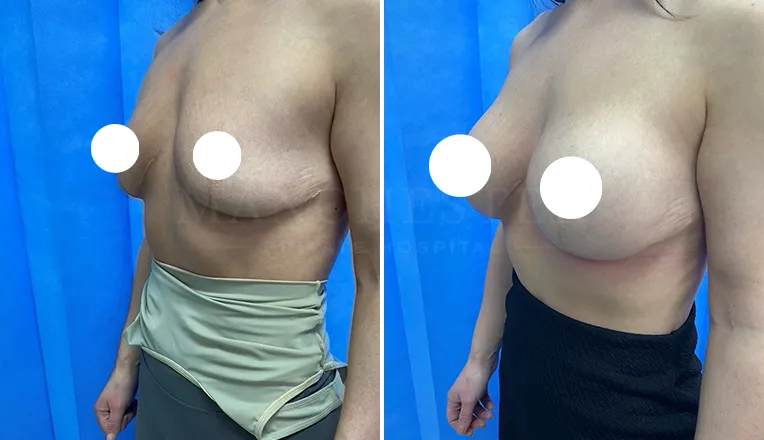 breast enlargement before and after patient - 2 - v2