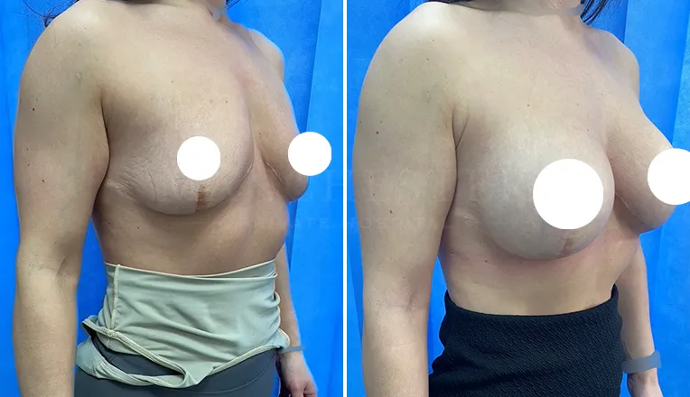 breast enlargement before and after patient - 2 - v4