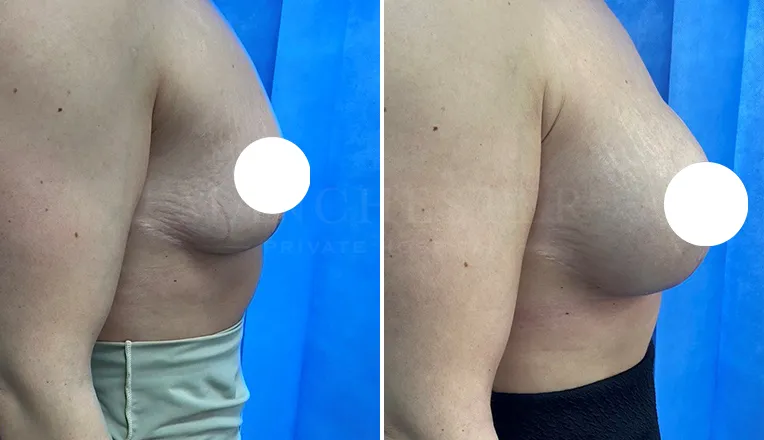 breast enlargement before and after patient - 2 - v5