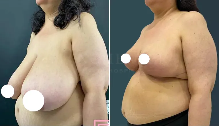 breast reduction before and after patient - 1 - v1
