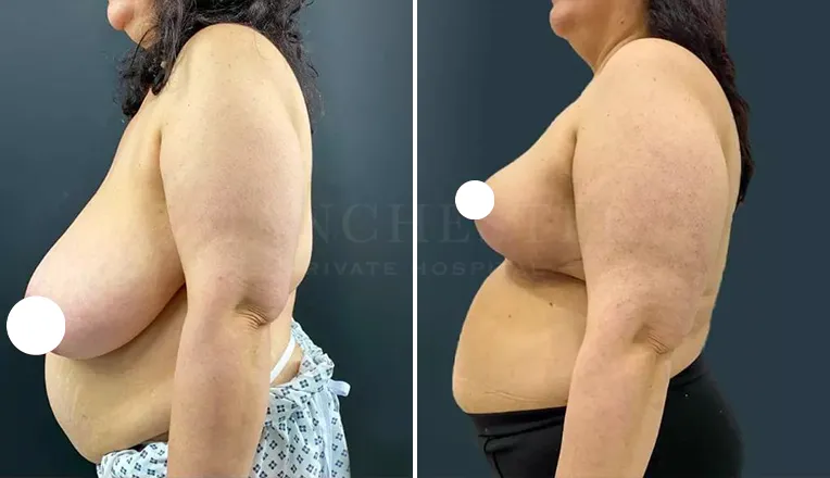 breast reduction before and after patient - 1 - v2