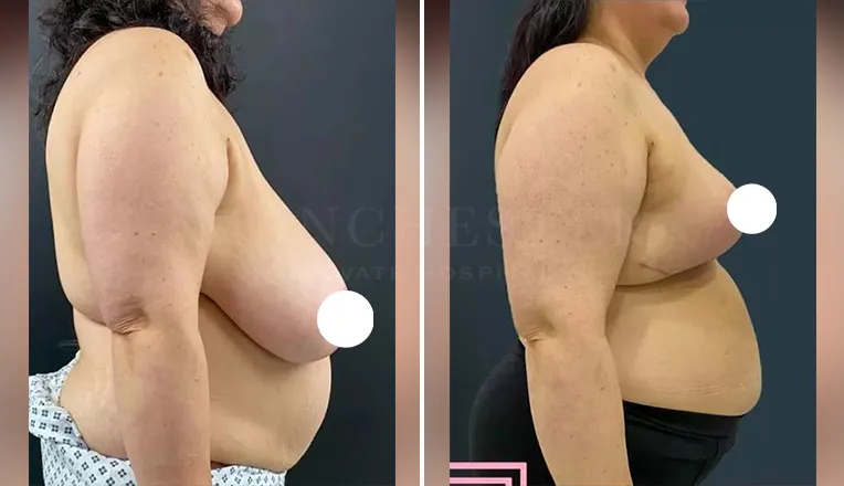 breast reduction before and after patient - 1 - v4