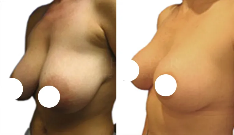 breast reduction before and after patient - 2 - v2