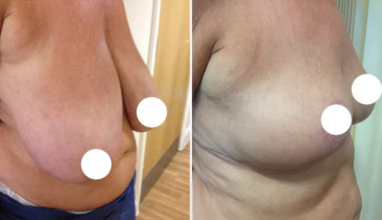 breast reduction before and after patient - 3 - v1