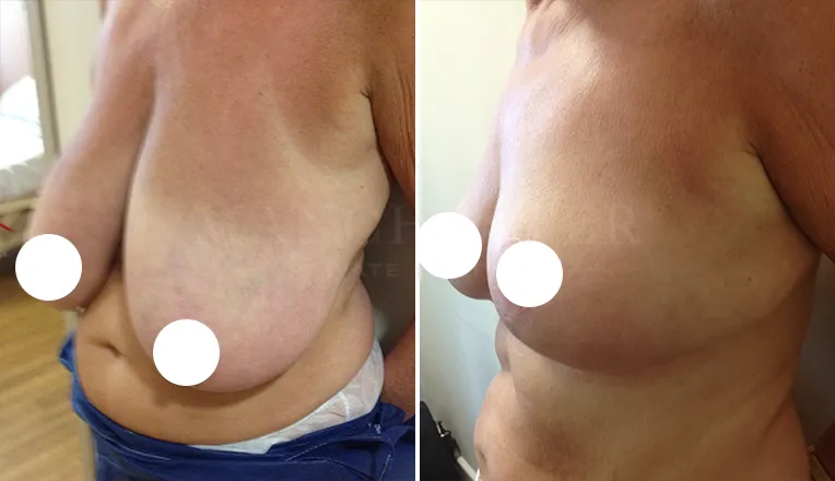 breast reduction before and after patient - 3 - v2