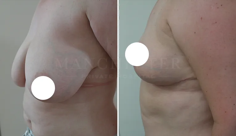 breast reduction before and after patient - 3