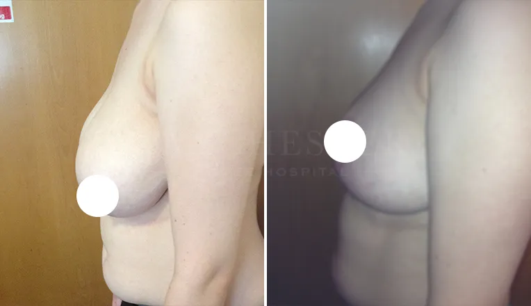 breast reduction surgery before and after patient - 3