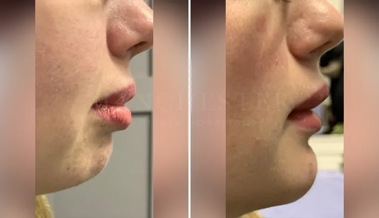 chin implants before and after patient - 1