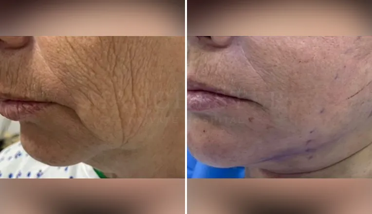 facelift before and after patient - v2