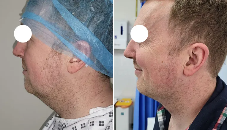 facial vaser lipo before and after patient -1 - v1