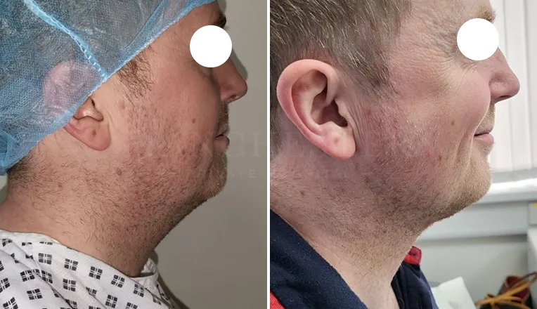 facial vaser lipo before and after patient -1 - v2