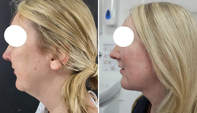 facial vaser lipo before and after patient -2 - v1