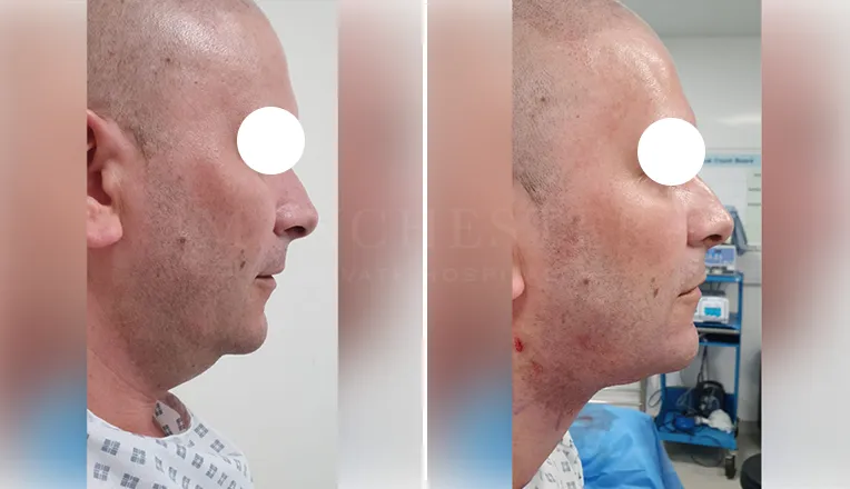 facial vaser lipo before and after patient -3
