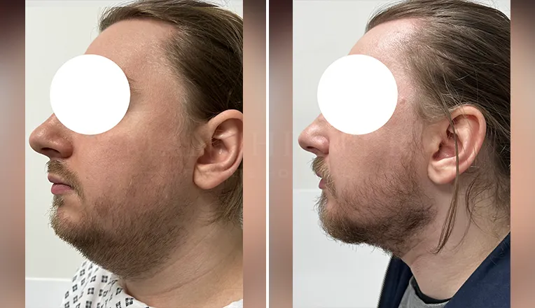 facial vaser liposuction before and after patient -1 - v2