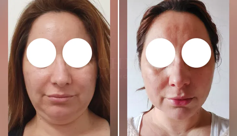 facial vaser liposuction before and after patient -1