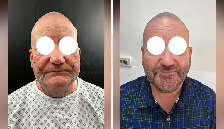 facial vaser liposuction before and after patient -2 - v1