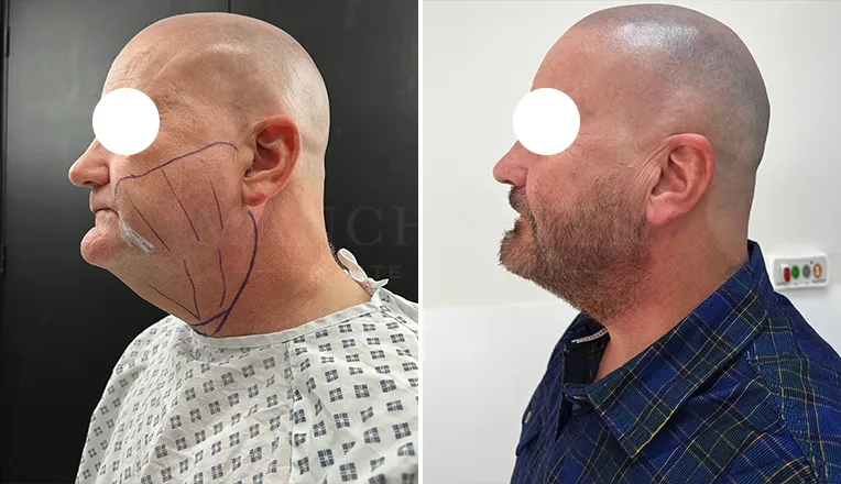 facial vaser liposuction before and after patient -2- v2