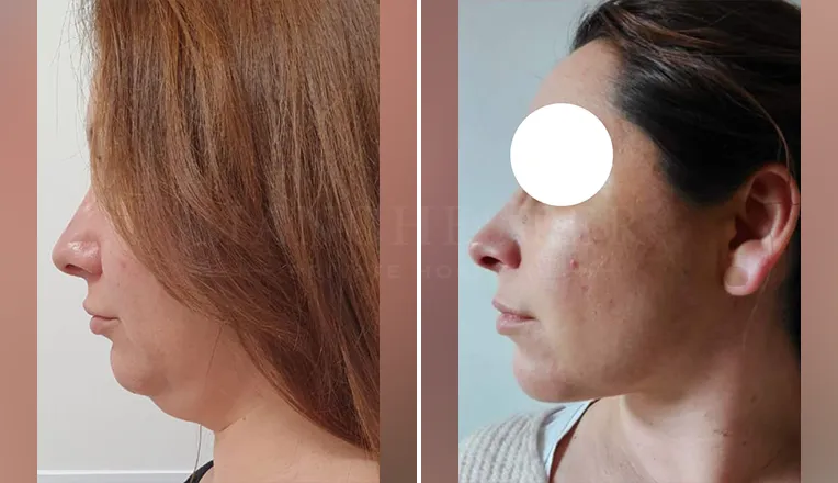 facial vaser liposuction before and after patient -2