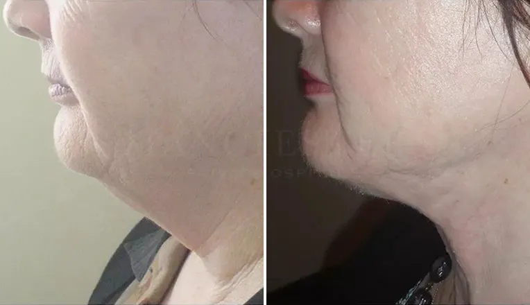facial vaser liposuction before and after patient -3