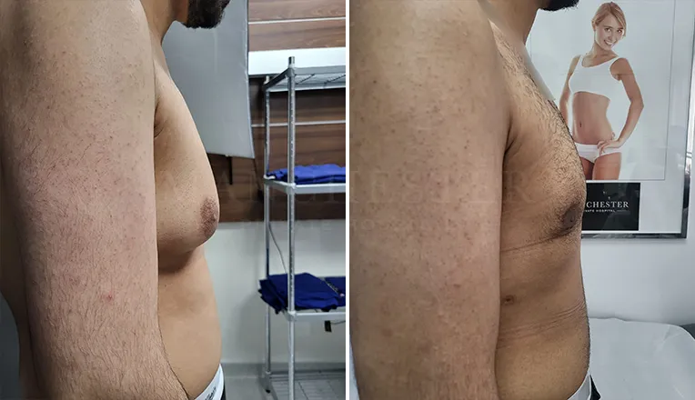gynecomastia before and after patient -1 - v2