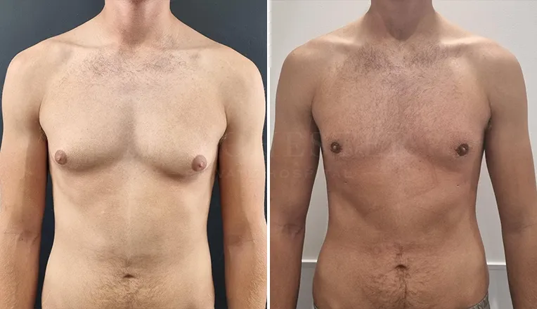 gynecomastia before and after patient -2 - v1