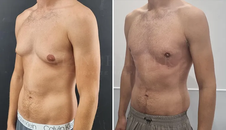 gynecomastia before and after patient -2 - v2