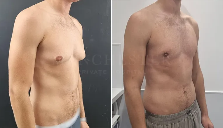 gynecomastia before and after patient -2 - v3
