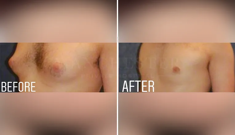 gynecomastia before and after patient -2
