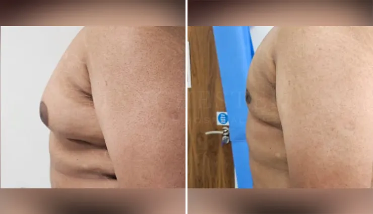 gynecomastia before and after patient -3 - v1