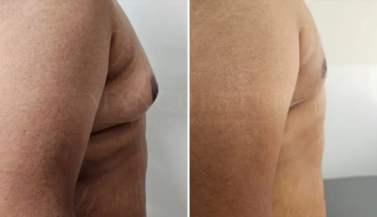 gynecomastia before and after patient -3 - v2