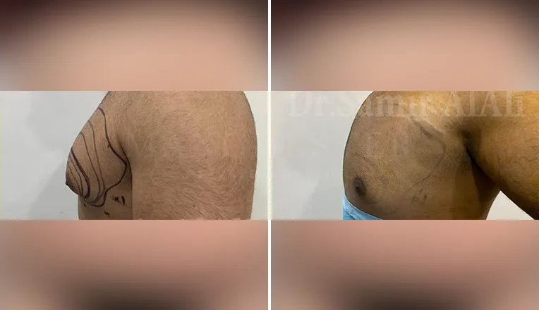 gynecomastia before and after patient -5 - v1