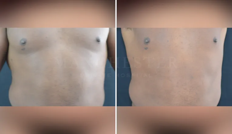 gynecomastia before and after patient -5